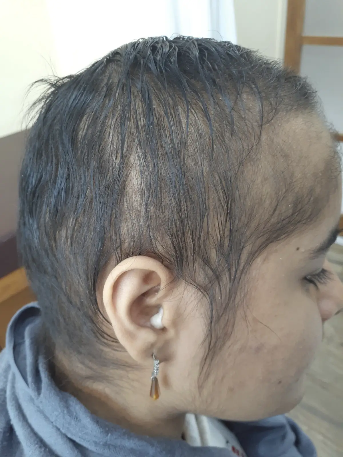 Alopecia Areata case 2 after treatment